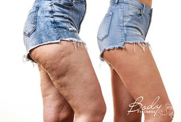 Anticelulitis con Presoterapia 