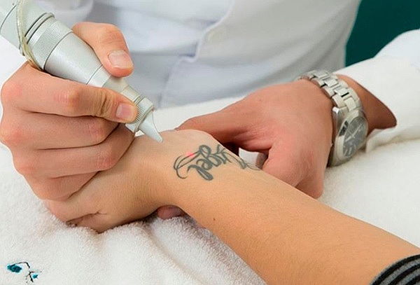 4 Sesiones Retiro de Tatuaje con Láser Pico