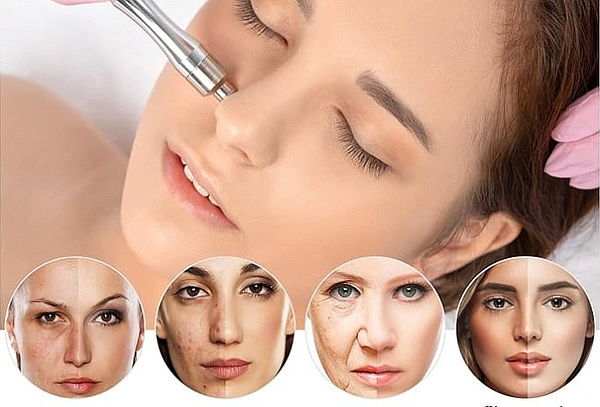2 Sesiones Microdermoabrasión + Mascarilla Vitamina B3