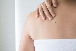 Eliminación de verrugas y lunares con electrocauterio