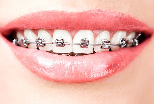 Brackets Metálicos + Limpieza y más
