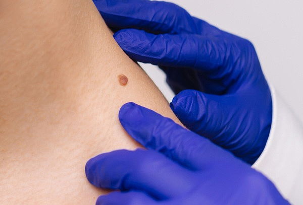 Eliminación de 15 Verrugas o Lunares 