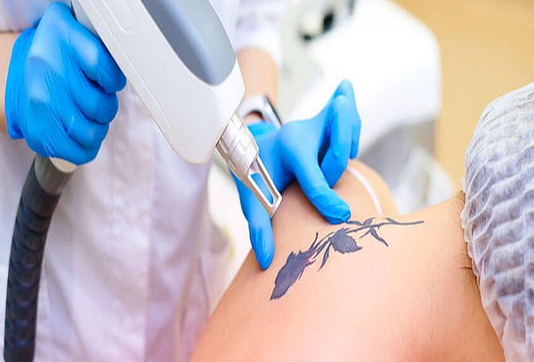 Eliminación de Tatuajes Láser ND YAG Q Switched  