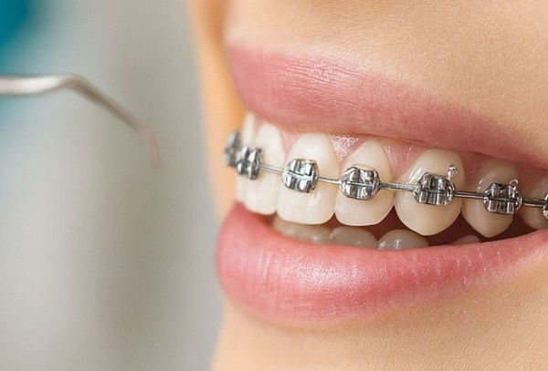 Brackets Inteligentes Metalicos + Diagnostico + Bono Regalo