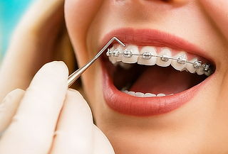 Brackets Inteligentes Metalicos + Diagnostico + Bono Regalo