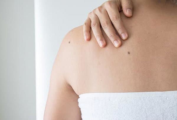 Eliminación de verrugas y lunares con electrocauterio