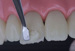 Resinas Esteticas + Desinfección con Ozono