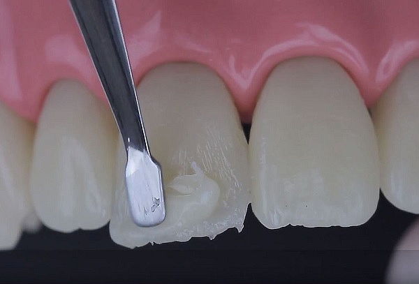 Resinas Esteticas + Desinfección con Ozono