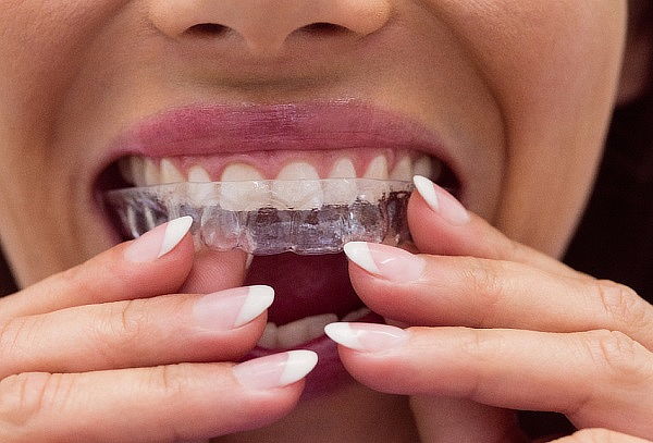 Simulación Digital 3D para Alineadores Invisibles