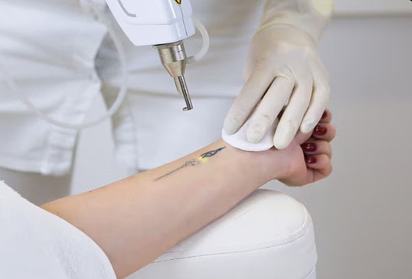 1 Sesión de Eliminación de Tatuaje con Picolaser