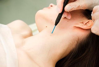 Eliminación de hasta 10 Verrugas con Plasma Fibroblast