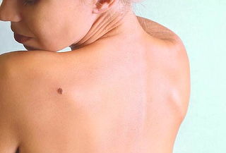 Eliminación de verrugas y lunares con crioterapia