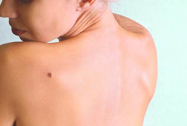 Eliminación de verrugas y lunares con crioterapia