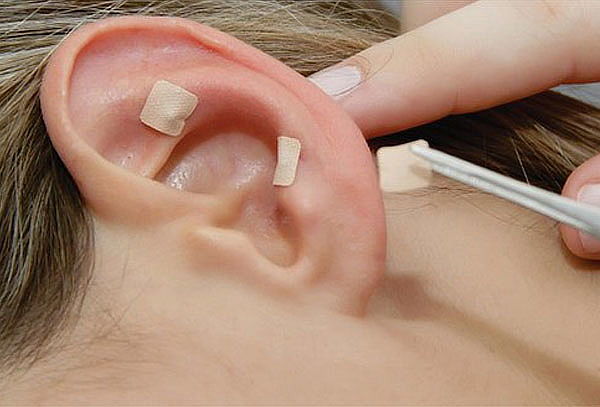 Baja hasta 8 Kg con Tratamiento de Auriculoterapia