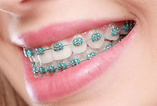 Colocación de Brackets mini americanos en todos los dientes.