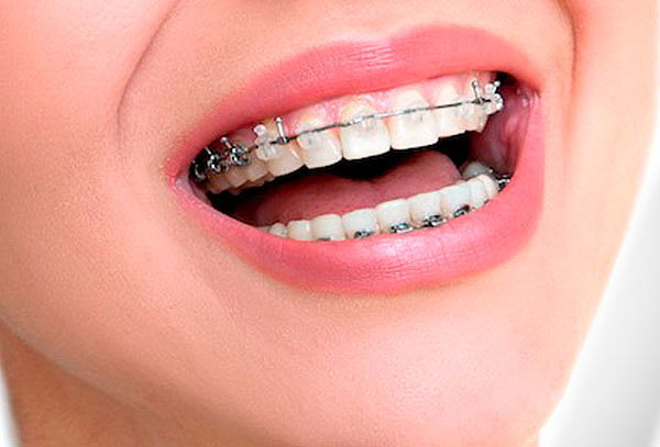 ¡Instalación de Brackets y Más! en Pueblo Libre 