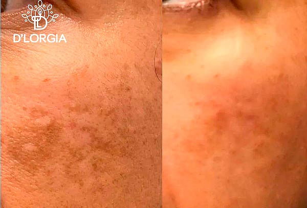 ¡elimina Las Manchas Melasma Lentigos Solares Y Más Ofertop