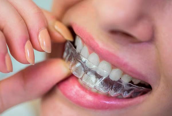 Férula Miorelajante de Acetato + Evaluación y más - Stardent