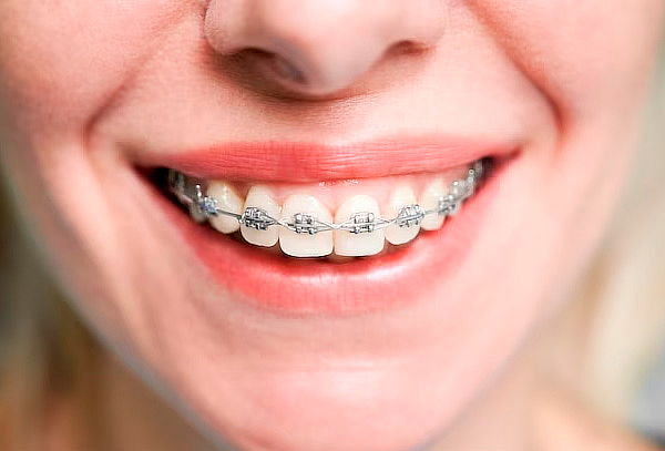 Brackets Metálico ó Transparente + Blanqueamiento - 2 Sedes