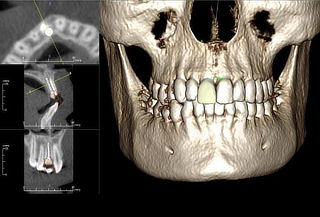 Tomografía Dental Computarizada 3D + Entrega de imagenes