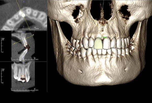 Tomografía Dental Computarizada 3D + Entrega de imagenes