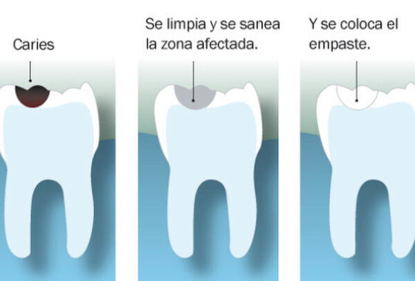 4 Curaciones simples + Profilaxis + Odontograma + Flúor