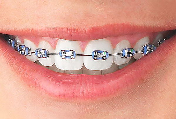 Brackets Metálicos, Transparentes o Mini Brackets y Más