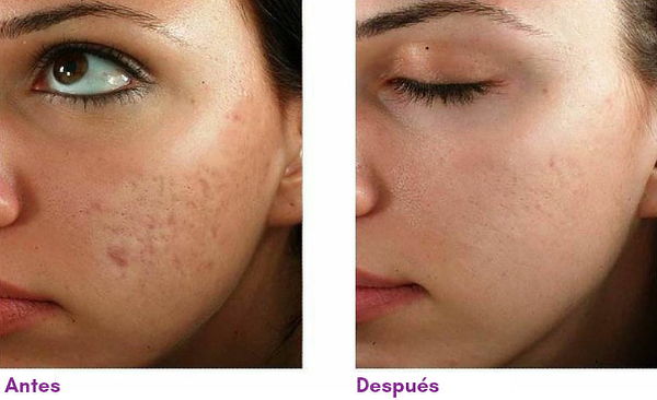 Dermapen para secuelas de acné 