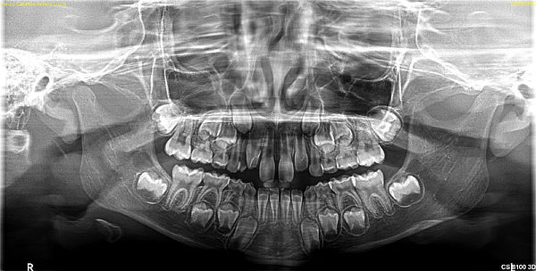 Radiografía Panorámica en Digital para Niños