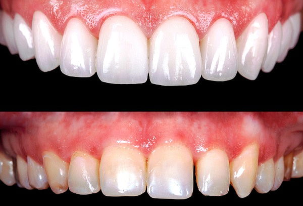 Blanqueamiento Dental + Profilaxis ¡DIENTES BLANCOS! 