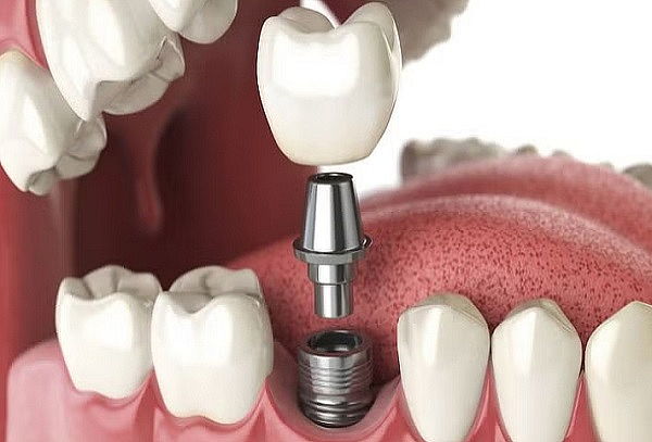 DSCTO. IMPLANTE Dental de Titanio + Colocación + Profilaxis