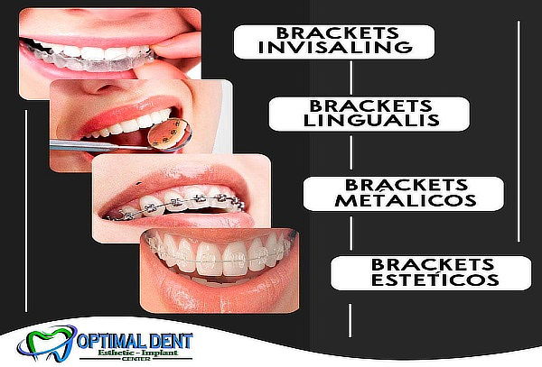 Brackets sin cuota inicial