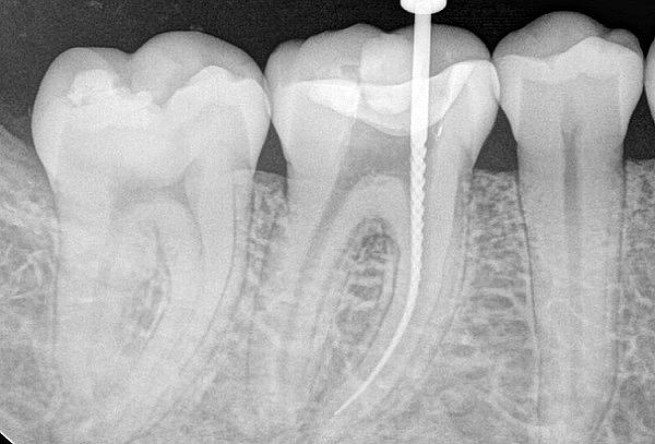 Endodoncia + Radiografía + Sistema Rotatorio