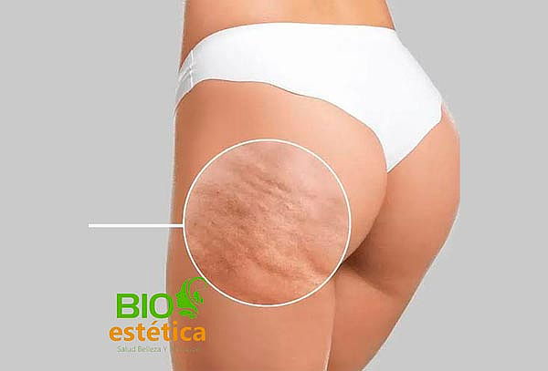 Tratamiento Anticelulitis: 2 Sesiones Carbox + Masajes 