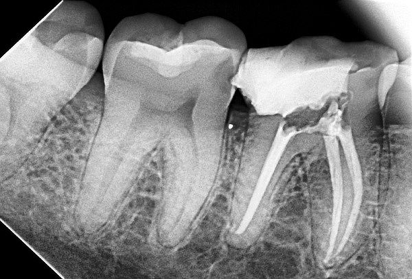 Endodoncia sin dolor + Radiografía digital