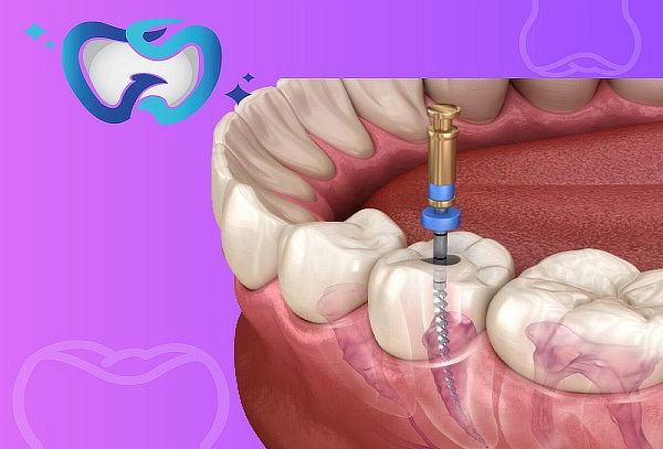 Endodoncia sin dolor + Radiografía digital