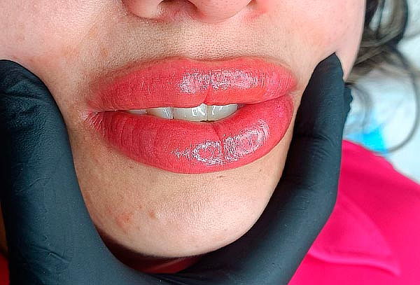 Aumento de Labios con Acido Hialurónico en VIP Lyanna 