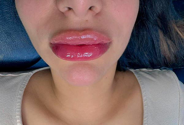 Aumento de Labios con Acido Hialurónico en VIP Lyanna 