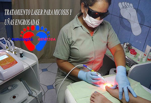 Pódología Laser 4 Sesiones 