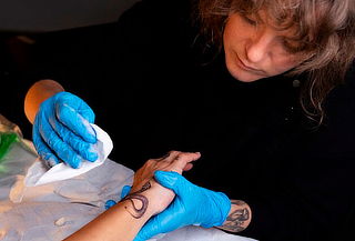 Remoción de Tatuaje con Láser Q-Switched Nd:YAG hasta 5x5 cm