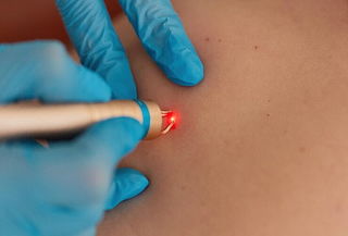 Cauterización de Lunares y Acrocordones + Diagnostico