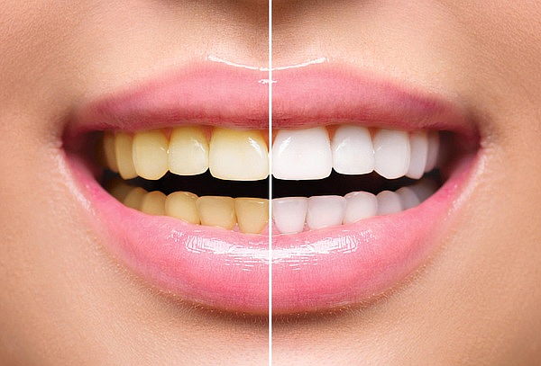 2 Sesiones de Blanqueamiento dental + Destartraje + Flúor