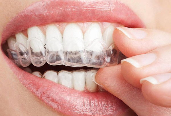 Blanqueamiento: Férula + Profilaxis + Consulta + Odontograma