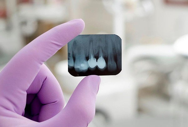 Consulta Odontológica + Profilaxis + Radiografía Periapical