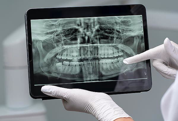 Evaluación + 01 Radiografía Peri-apical Y Profilaxis