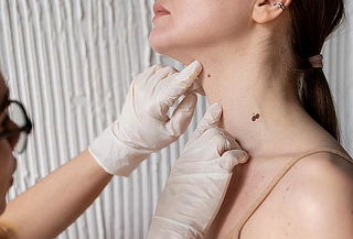 Cauterización de Lunares y Acrocordones 