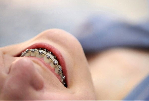 Paquete Integral Ortodoncia: Brackets + Limpieza y más