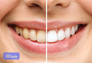 3 Ses de Blanqueamiento + Profilaxis + 2 Curaciones Simples