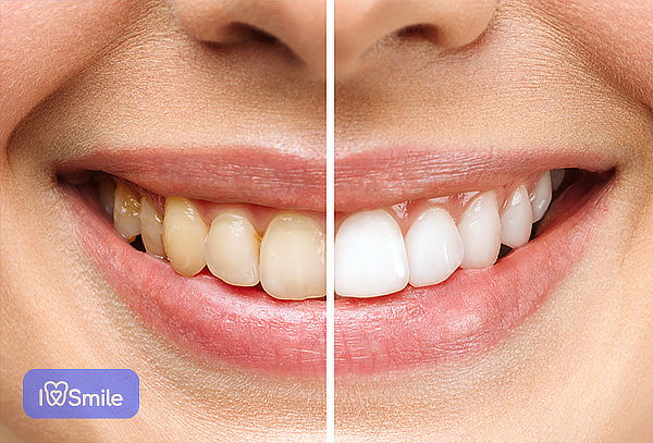 3 Ses de Blanqueamiento + Profilaxis + 2 Curaciones Simples