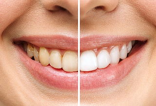 3 Ses de Blanqueamiento + Profilaxis + 2 Curaciones Simples